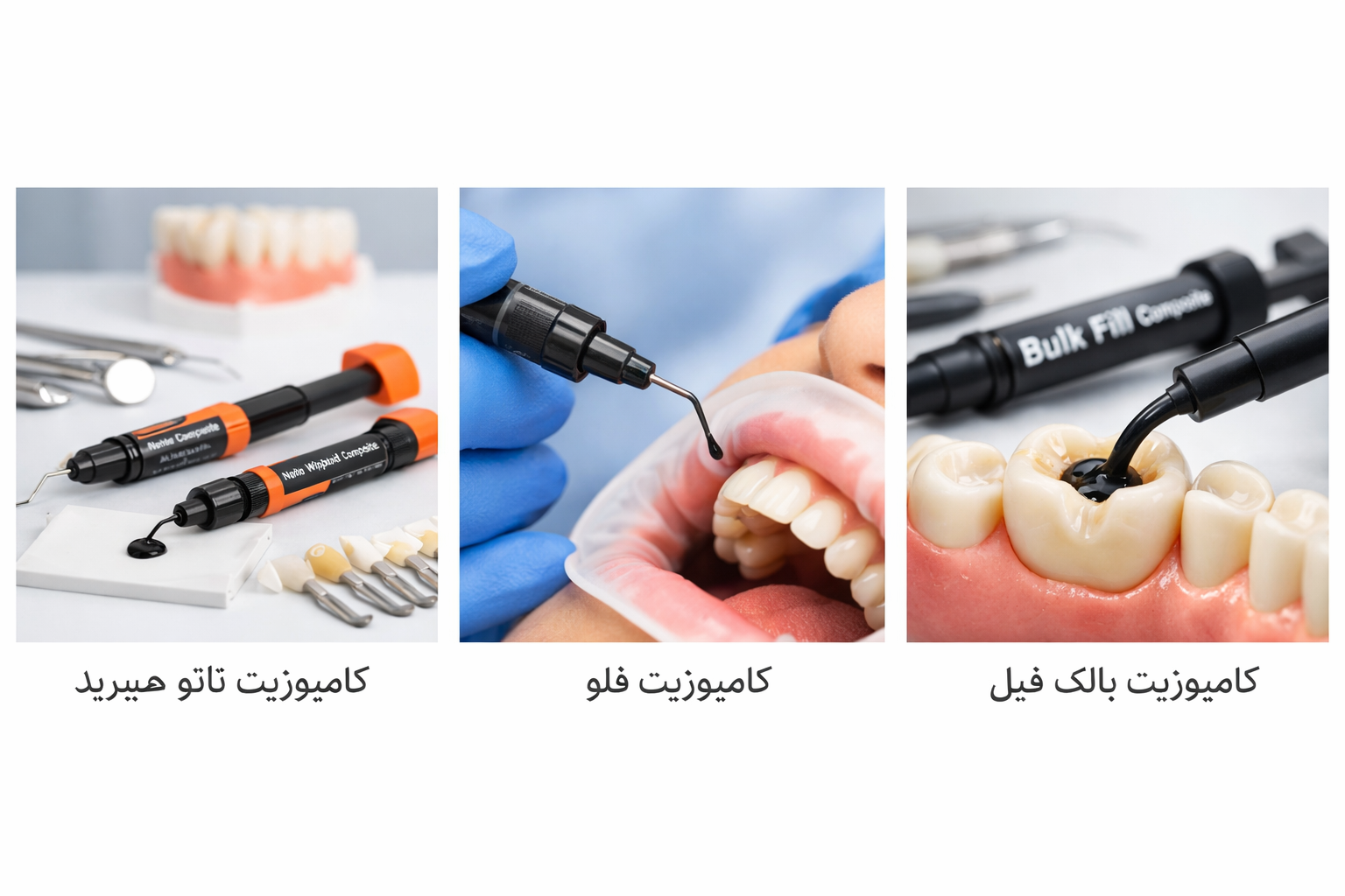 انواع کامپوزیت دندان