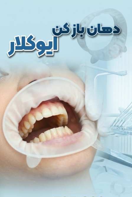 دهان باز کن اپتراگیت ایوکلار مدل OptraGate